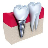 single crown implant (Shutterstock)