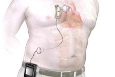 Sunshine Heart's C-Pulse System approved for trial