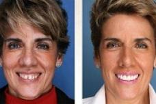 Beverly Hills dentist offers anti-aging alternative solution