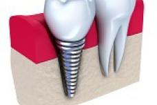 Aging population drives global dental implants market