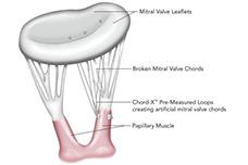 On-X LTI highlights mitral valve repair solution