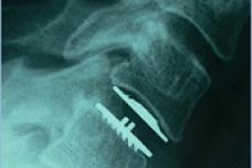 Dual level cervical disk implant gets FDA approval