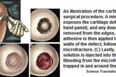 Knee cartilage repair success with new biomaterial