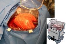 World first: Donor lungs preserved 11 hours