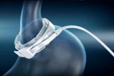 Weight loss surgery and long-term anti-diabetes benefits
