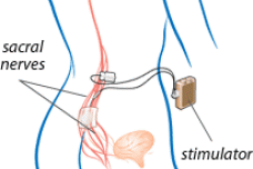 Positive data for Medtronic’s InterStim bladder device