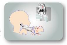 New nasopharyngeal cancer screening test