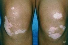 New study explores vitiligo’s link to autoimmune diseases
