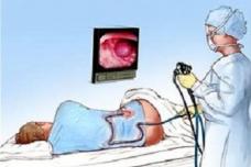 Colonoscopy reduces risk of advanced colorectal cancer