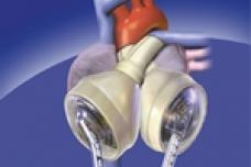 Cardiac implant patient marks a milestone