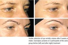Collagen peptides reduce eye wrinkles