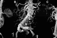 High success rate for chimney stent grafts