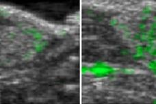 Improved ultrasound imaging helps detect tumours