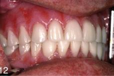 Positive results for implant dentistry
