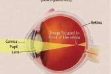 Contact lenses may halt nearsightedness in kids