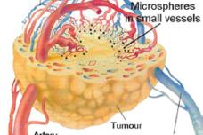 New website focuses on widely used form of SIRT for liver tumours