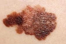 Single injection may revolutionize melanoma treatment