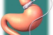 Is bariatric surgery worth it?