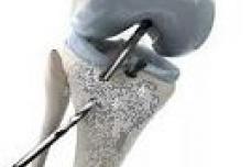 Advances in arthroscopy to transform surgical techniques