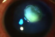 Scary risks of cosmetic contact lenses