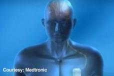 Alzheimer's patient implanted with brain pacemaker