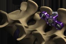 ZIP ULTRA MIS in first surgical implant