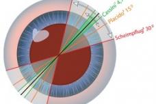 ‘Spectacle free’ cataract refractive procedure