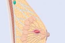 Survival improves with lumpectomy for stage I, II breast cancer
