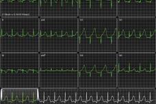 Up-to-the Moment ECG Data on iOS Devices