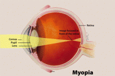 Gene mutations associated with myopia identified