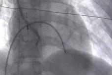 Cardiology team performs 100th extraction procedure