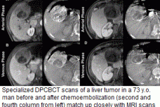 Paired CT scans catch chemo-killing of liver tumors in real time