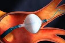 CARDIAC CRYOBALLOON