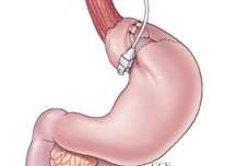 Bariatric surgery may turn back effects of aging