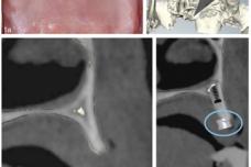 Successful computer-guided implant