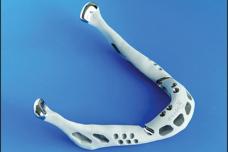 World’s First Patient-Specific Total Lower Jaw Implant