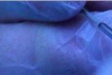 Mauna Kea's optical biopsy probe receives CE Mark