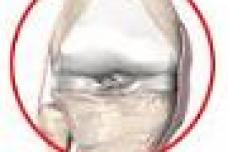 Stem cell drug tested on knee cartilage damage