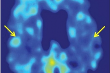 Imaging tool reveals early signs of Alzheimer's