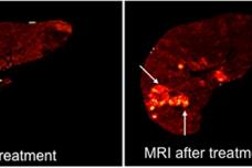 Exploiting holmium treatment for liver cancer
