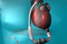 Potential benefits of LVAD to be examined