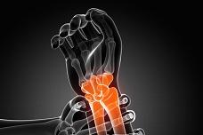 Research eyes early diagnosis of osteoarthritis